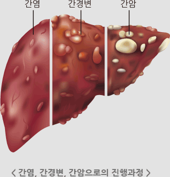 간염, 간경변, 간암으로의 진행과정