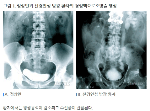 그림1:정상인과 신경인성 방광 환자의 경정맥요로도영술 영상