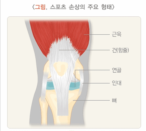 <그림. 스포츠 손상의 주요형태>근육,건(힘줄),연골,인대,뼈>