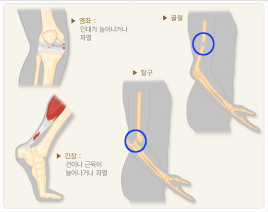 염좌:인대가 늘어나거나 파열,골절,탈구,긴장:건이나 근육이 늘어나거나 파열