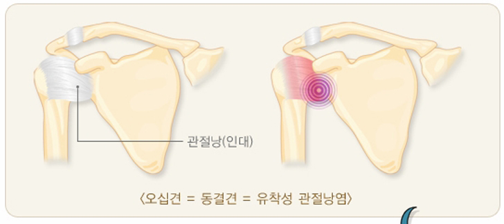 <오십견=동결견=유착성 관절낭염>