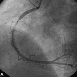 관상동맥 조영술 사진