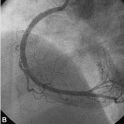 관상동맥 조영술 사진