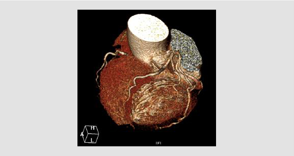 관상동맥 전산화 단층촬영 혈관조영술 영상