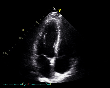 경흉부 심장초음파 검사