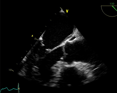 경식도 심장초음파 검사