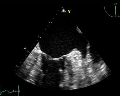 경식도 심장초음파 검사