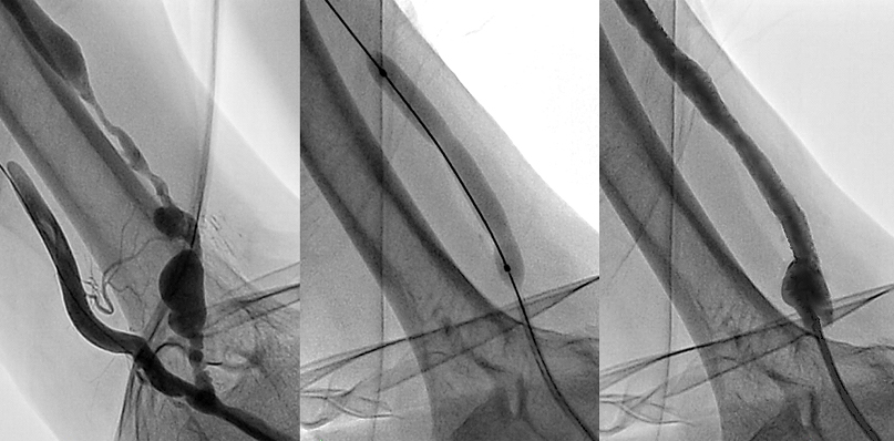 폐쇄된 혈액투석용 동정맥루를 경피적 혈관 성형술로 치료하는 사진