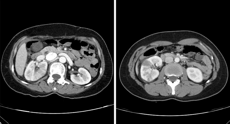 신우신염 CT사진