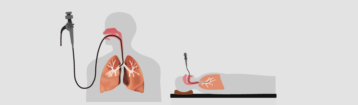기관지내시경 검사