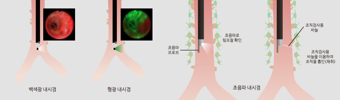 기관지 내시경의 다양한 형태들