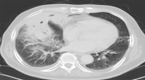 폐렴의 감별을 위해 흉부전산화단층촬영을 한 사진
