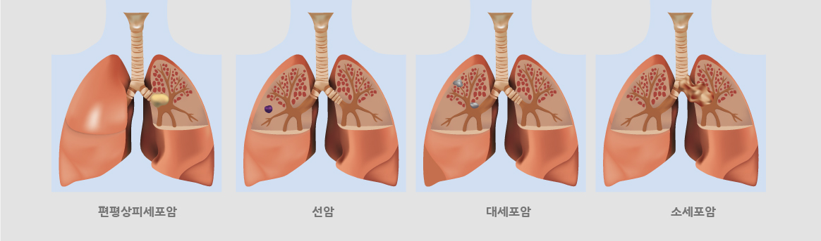 편평상피세포암,선암,대세포암,소세포암