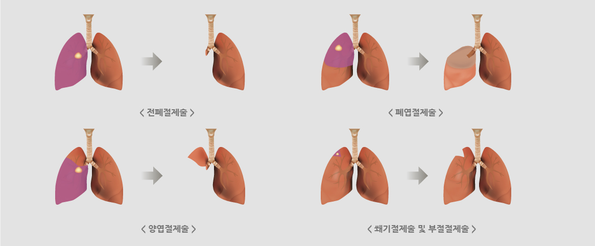 전폐절수술,폐엽절제술,양엽절제술,쐐기절제술 및 부절절제술