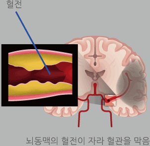 혈전,뇌동맥의 혈전이 자라 혈관을 막음