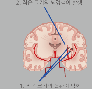 1.작은크기의 혈관이막힘,2.작은크기의 뇌경색이 발생