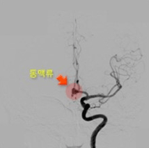동맥류 앞면사진