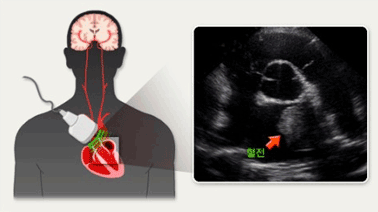 허혈성 뇌졸중의 MRI 소견