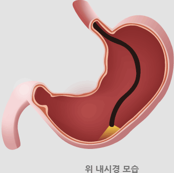 위 내시경 모습