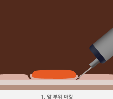 1.암 부위 마킹