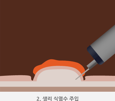 2.생리식염수 주입