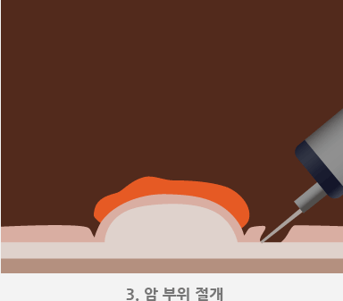 3.암 부위 절개