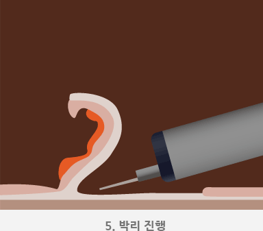 5.박리 진행