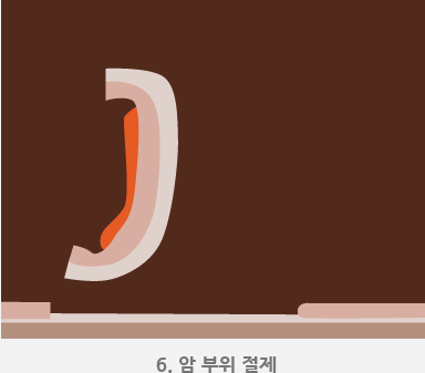 6.암 부위 절제