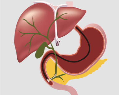 내시경 역행성췌담도 조영술(ERCP)의 과정