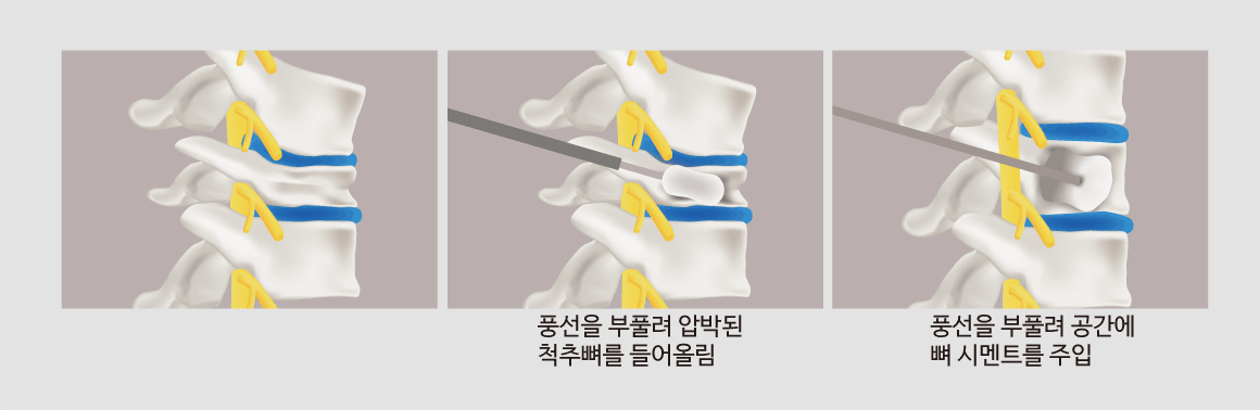 풍선을 부풀려 압박된 척추뼈를 들어올림,풍선을 부풀려 공간에 뼈 시멘트를 주입