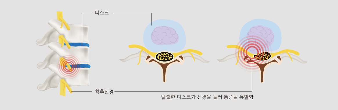 디스크,척추신경,탈출한 디스크가 신경을 눌러 통증을 유발함