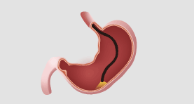 위 내시경