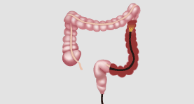 대장 내시경