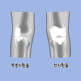 걸을 때 통증 발생, 관절염 의심해봐야
