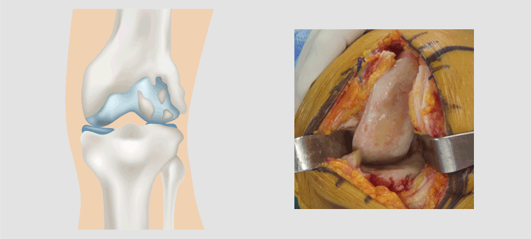 내측부분만 마모된 무릎 관절