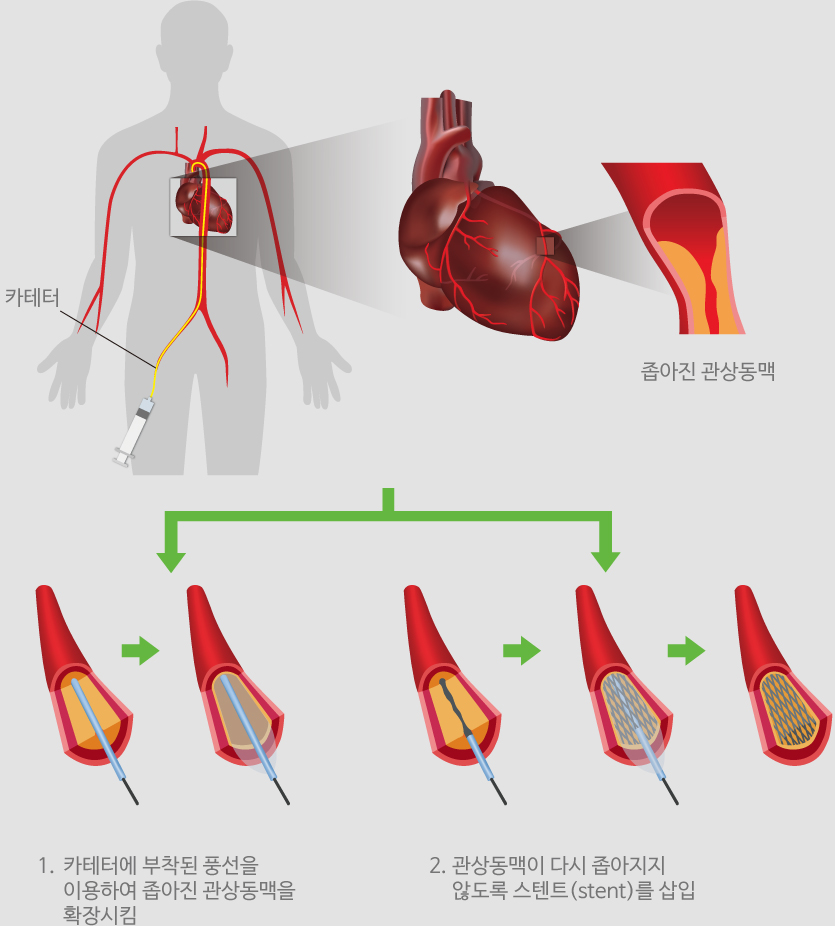 관상동맥 협착증을 풍선과 스텐트를 이용하여 치료하는 사진