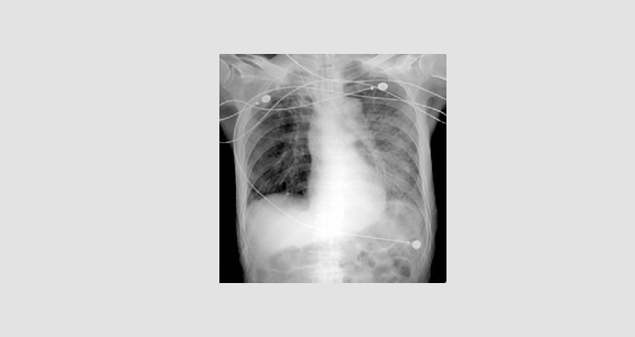 전형적인 폐렴의 흉부사진