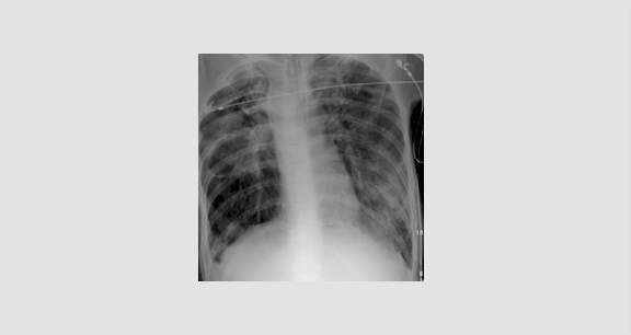 폐렴과 유사해 보이는 폐결핵 사진