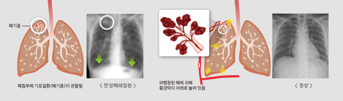폐첨부에 기포질환(폐기종)이 관찰됨,<만성폐쇄질환>,과팽창된 폐에 의해 황경막이 아래로 눌려있음,<정상>