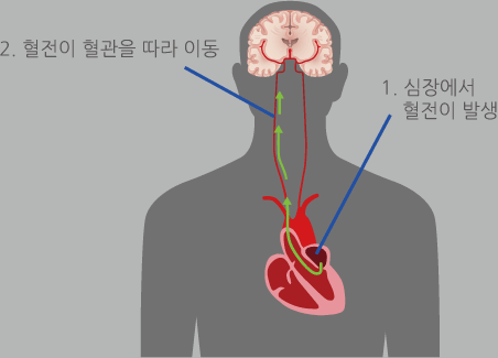 1.심장에서 혈전이 발생,2.혈전이 현관을 따라 이동