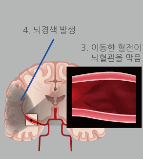 3.이동한 혈전이 뇌혈관을 막음