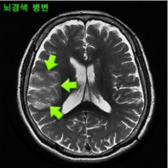 허혈성 뇌졸중의 MRI 소견